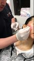 TCA Cross / Acne Scar Treatment Beverly Hills, CA / Asian Skin / Chemical Peel For Acne http://BestDramaTv.Net