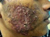 severe acne treated with chemical peeling http://BestDramaTv.Net