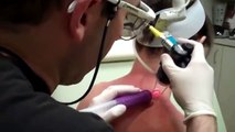 (Deep FX) Fractional Co2 Laser on Back for Acne Scars with Dr. Seiler http://BestDramaTv.Net