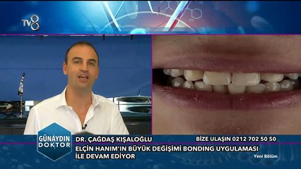 Bonding ile Büyük Değişim