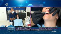 Diş Beyazlatma ve Bonding İşlemi Nasıl Yapılır ?