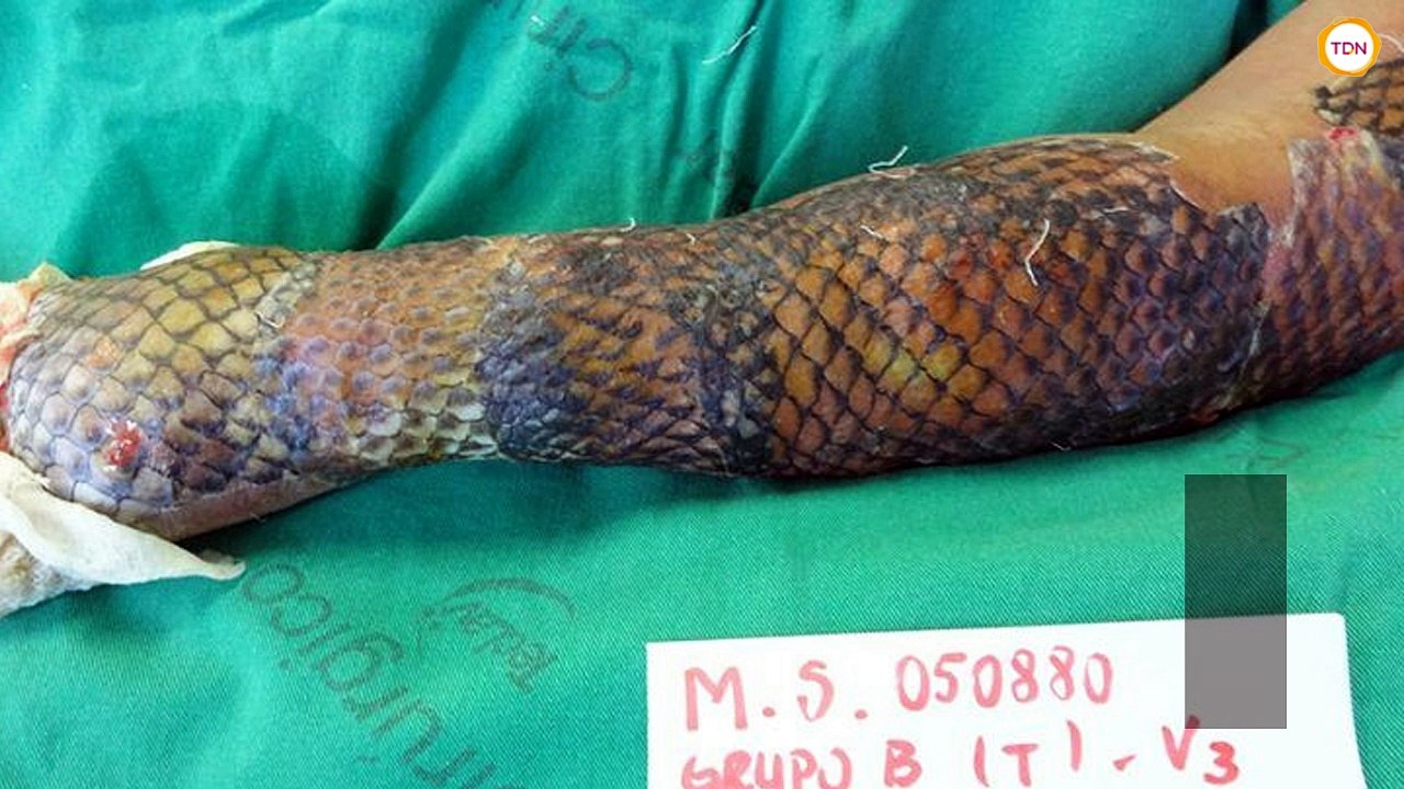 Les bienfaits de la peau de tilapia chez les grands brûlés