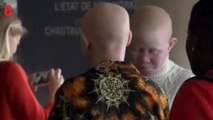 Tanzanie: quatre enfants albinos vont se faire soigner aux États-Unis