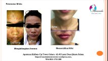 0811 1721 280, Agar hidung mancung di Jakarta Selatan Rinanda  Skin Care Center