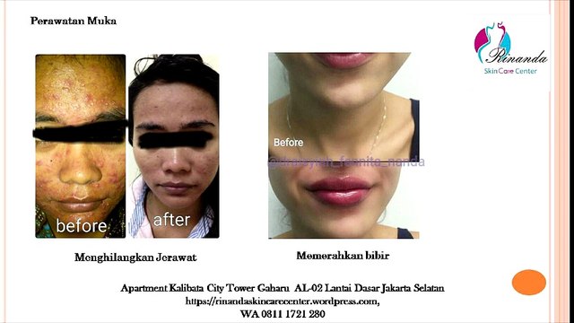 0811 1721 280, Agar wajah cantik di Jakarta Selatan Rinanda Skin Care Center