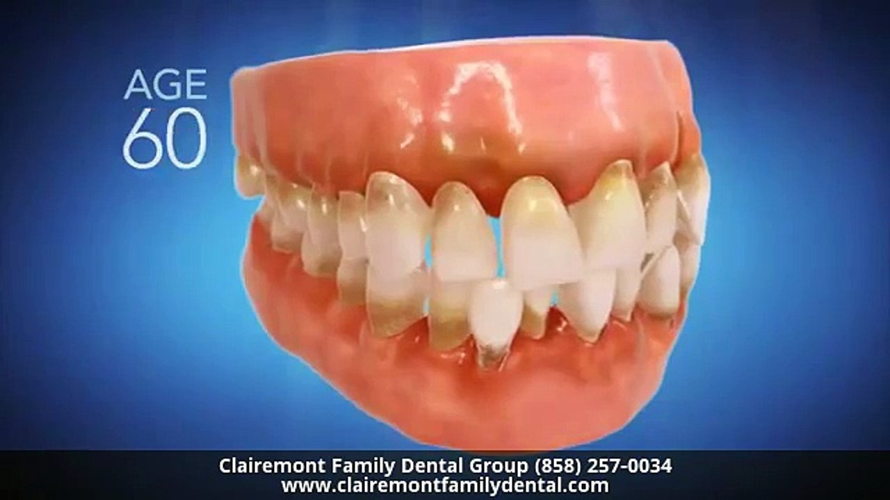 Invisalign Dentist San Diego CA