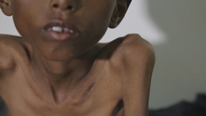 La hambruna será un escenario real en el Yemen si el conflicto continúa