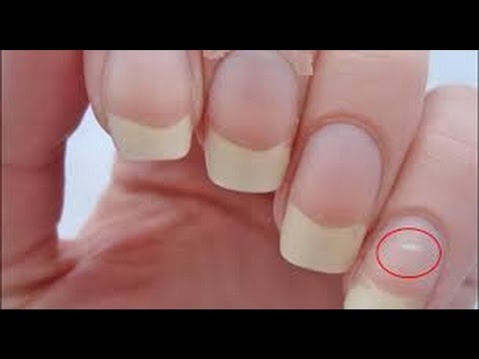 Sự Thật Về Đốm Trắng Trên Móng Tay, Móng Chân Ai Cũng Từng Bị Nhưng Không Biết Nguyên Nhân