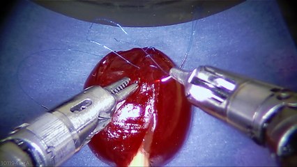 Suture médicale réalisée par un robot autonome