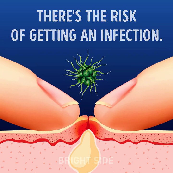 Evo zašto nikada ne treba da cijedite bubuljicu, ali baš NIKADA!