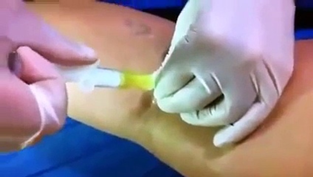 Baker's Cyst 2016 YouTube