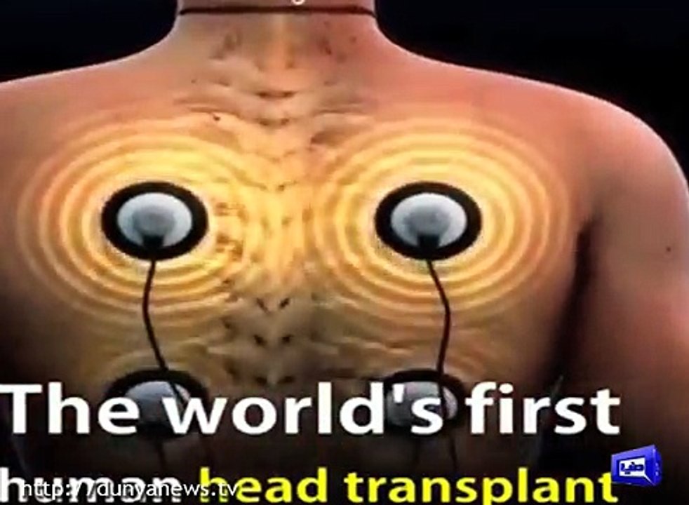 29MAR17-PKG-HEAD-TRANSPLANT-2400