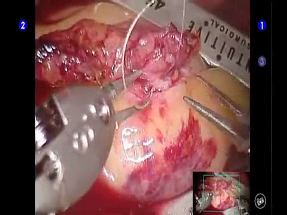 robotic-surgery-demonstration-using-da-vinci-surgical-system.