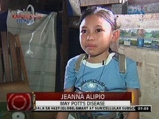 Dalagang dinapuan ng Pott's disease o Tuberculosis of the spine, nananawagan ng tulong medikal