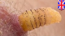 Gross! Flesh-eating maggots burrow into woman’s arm