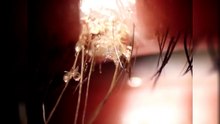 Elle pensait avoir une infection à l’œil, mais ce que le médecin lui annonce l’a vraiment dégoûtée