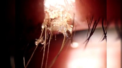 Elle pensait avoir une infection à l’œil, mais ce que le médecin lui annonce l’a vraiment dégoûtée