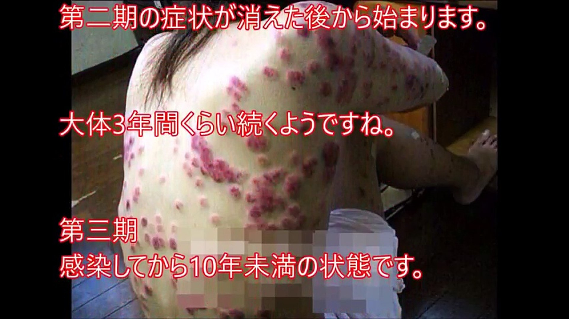 閲覧注意 梅毒患者の症状の末期がヤバすぎる 日本で近年増加しているけど予防法 治療法は グロ注意 Video Dailymotion