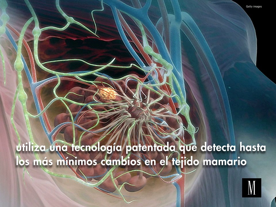 Braster, la nueva forma de prevenir el cáncer de mama