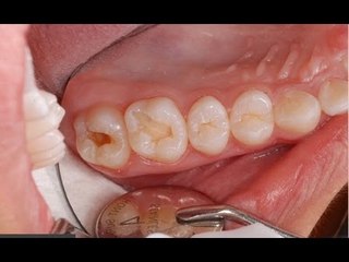 Chữa SÂU RĂNG Ngay Tại Nhà Đơn Giản vs Sức Khỏe và Đông Y