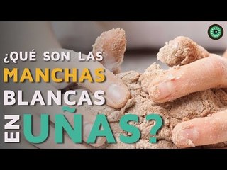 ¿Qué son las manchas blancas en las uñas?