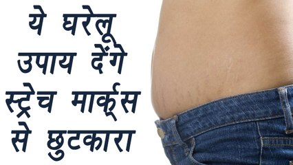 Stretch Marks treatment at home, ये घरेलू उपाय देंगे स्ट्रेच मार्क्स से छुटकारा | Boldsky