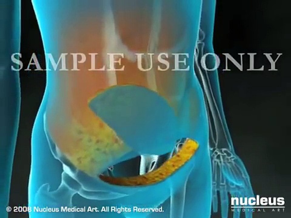 Breast Cancer _ Breast Reconstruction _ health point