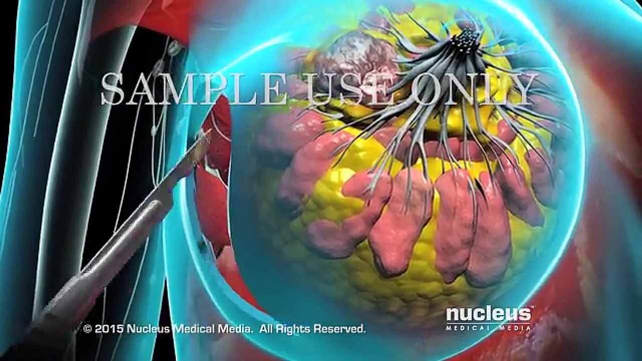 Breast Cancer _ Tumor Removal Surgery _ Health point