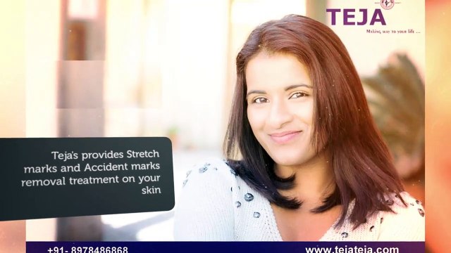 Stretch Marks & Accident marks Removal Services - Teja