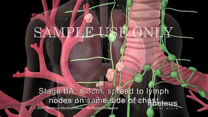 Lung Cancer Staging Non-small Cell