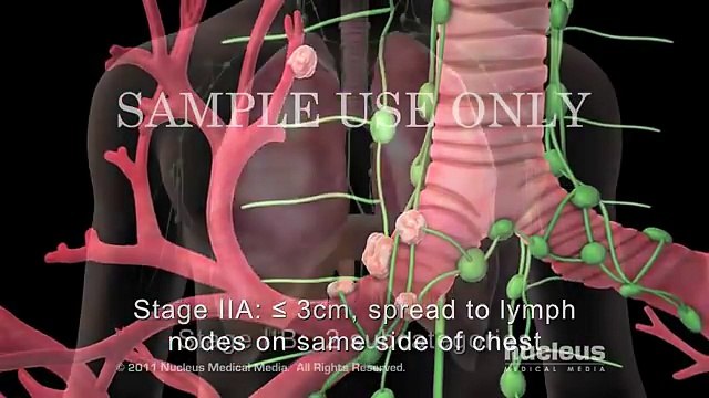 Lung Cancer Staging Non-small Cell