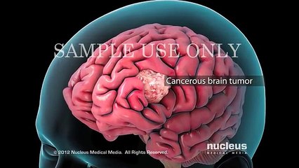 Cancer Treatment_ IMRT (Radiation Therapy)