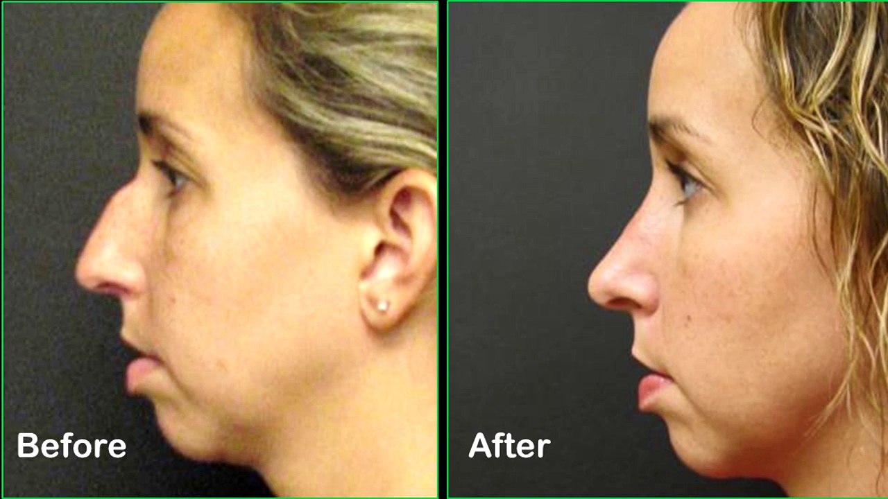 RINOPLASTIA LISBOA - ANTES E DEPOIS!!