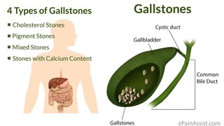 Gallstones - What Increases Your Risk