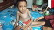 Anak laki-laki di Bandung menderita kelainan genetik tulang rapuh - TomoNews