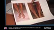 Capital : Une jeune femme a les jambes brûlées après une épilation au laser, les images chocs ! (Vidéo)