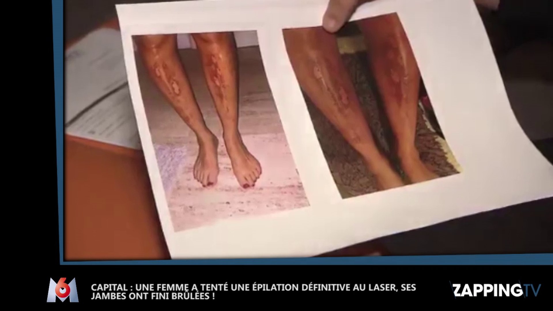 Capital : Une jeune femme a les jambes brûlées après une épilation au  laser, les images chocs ! (Vidéo) - Vidéo Dailymotion