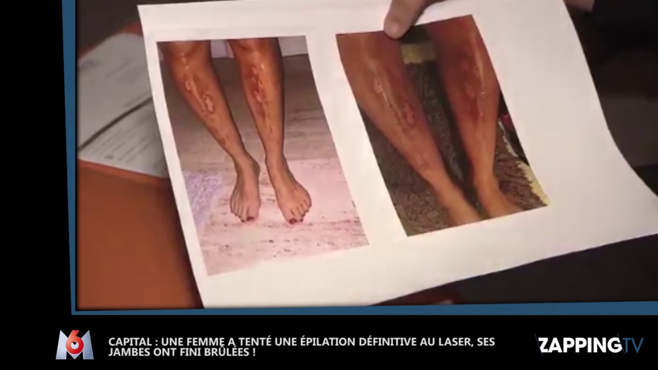 Capital : Une jeune femme a les jambes brûlées après une épilation au laser, les images chocs ! (Vidéo)