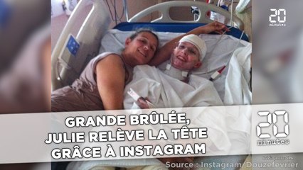 Grande brûlée,  Julie relève la tête grâce  à Instagram