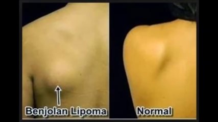 Penyebab Kanker Payudara