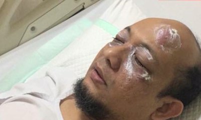 Novel Baswedan Diduga Disiram Air Keras