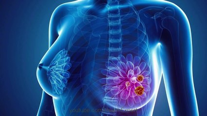Do You Know the Warning Signs of Breast Cancer_x264