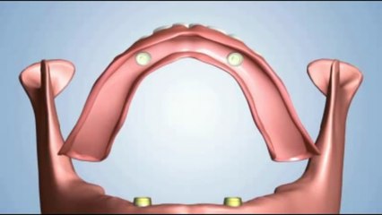 Options for replacing all your teeth