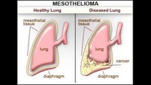 Top 10 Mesothelioma Law Firms in New York City-YhmW8MnPcJA