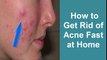 How to get rid of Acne fast at home overnight|Girls Face Beauty Tips|How to get glowing skin|pimples treatment and home remedies|Health and beauty tips