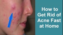 How to get rid of Acne fast at home overnight|Girls Face Beauty Tips|How to get glowing skin|pimples