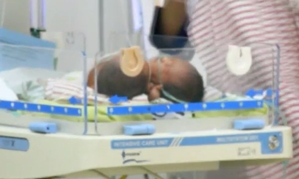 Kondisi Bayi Kembar Siam 2 Kepala 3 Tangan Mulai Membaik