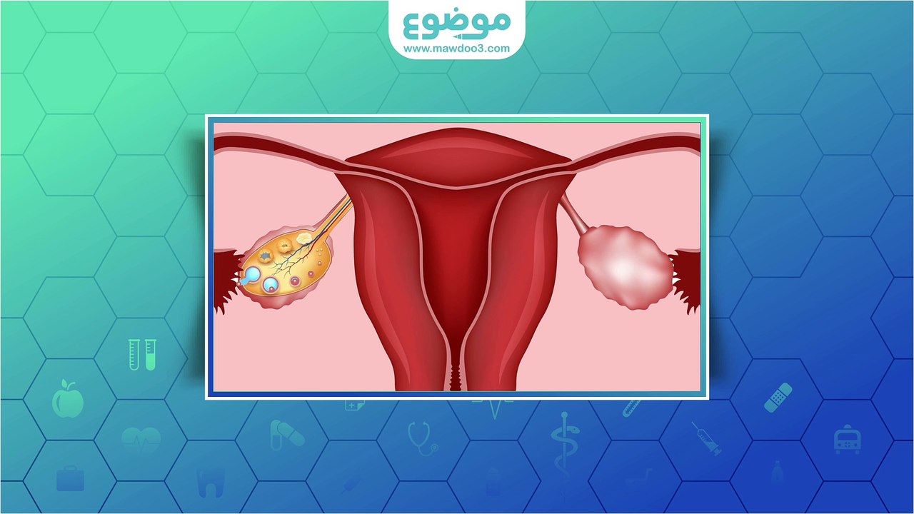 #موضوع: علاج ضعف المبايض