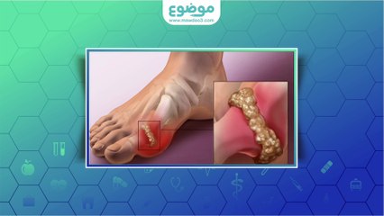 #موضوع: أعراض مرض النقرس