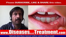 Canker sores : Causes, Symptoms, Diagnosis, Treatment, Prevention